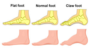 Flat Foot