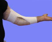 Elbow hyperextension taping