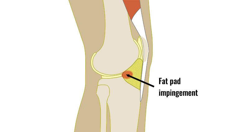 Fat pad impingement knee