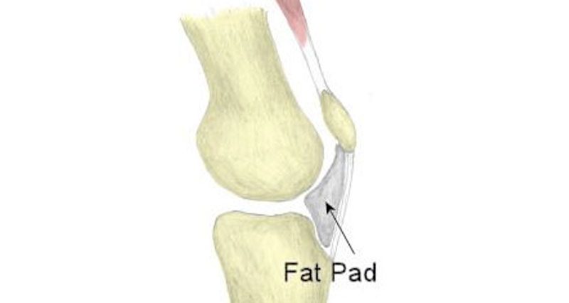 MRI Fat Pad Impingement Knee