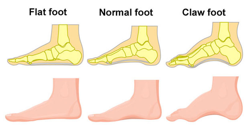 Flat feet & Claw foot
