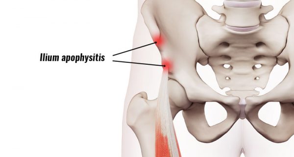 Ilium apophysitis