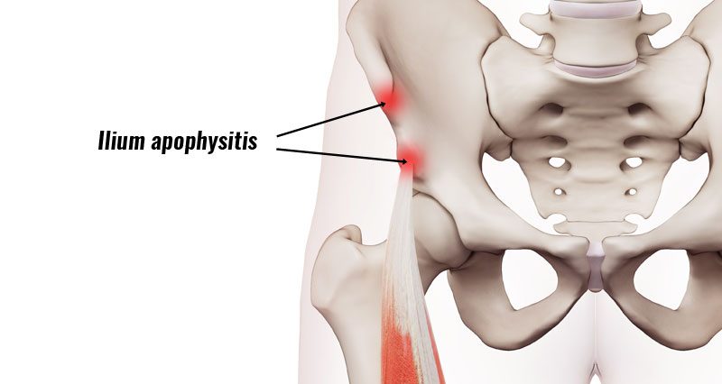 Ilium apophysitis