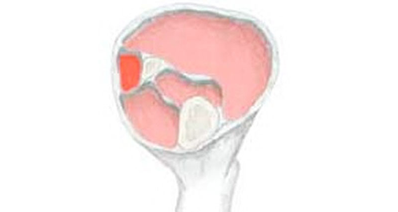 Lateral compartment syndrome