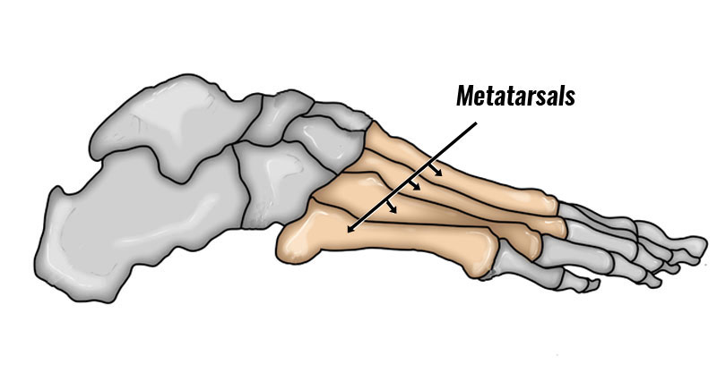 Metatarsal fractures