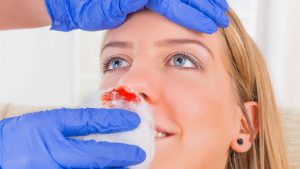 Nosebleed and facial injuries in sport