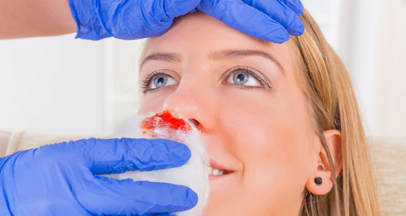 Nosebleed and facial injuries in sport