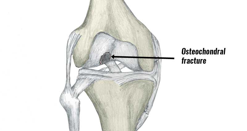 Osteochondritis dissecans