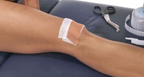 Patellofemoral pain taping