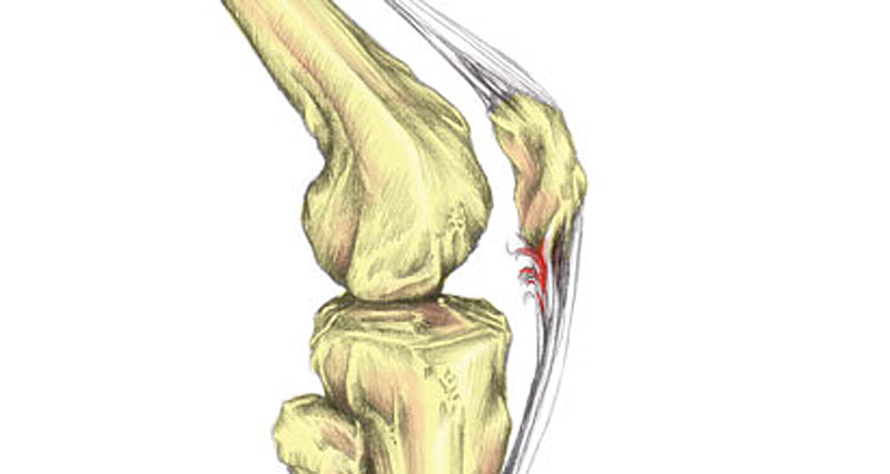 Patella tendon rupture