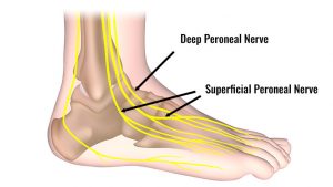 Peroneal nerve contusion