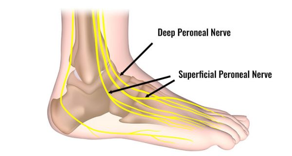 Peroneal nerve contusion