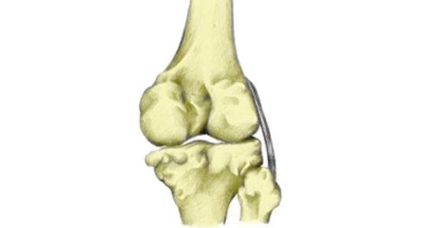 Posteriolateral corner injury