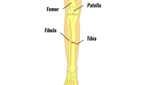 Tibia fracture
