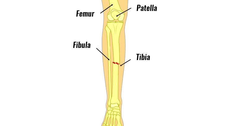 Tibia Fracture - Symptoms, Causes, Treatment & Rehabilitation