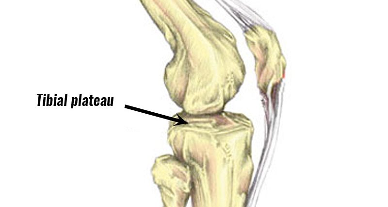 Tibial Plateau Fracture Symptoms Causes Treatment And Rehabilitation