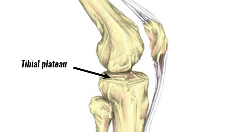 Tibial plateau fracture