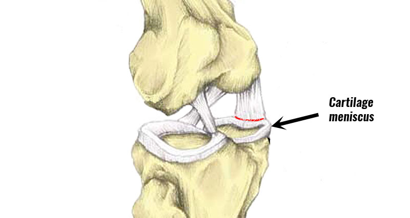 Torn cartilage meniscus
