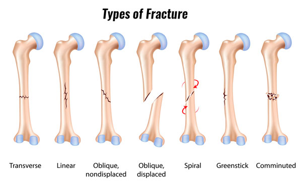 Types of bone fracture