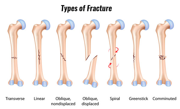 Broken Leg: If my tibial shaft fracture gets surgery, when can I