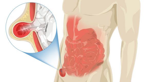 Inguinal hernia