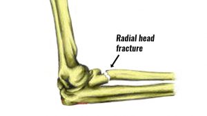 Radial head fracture
