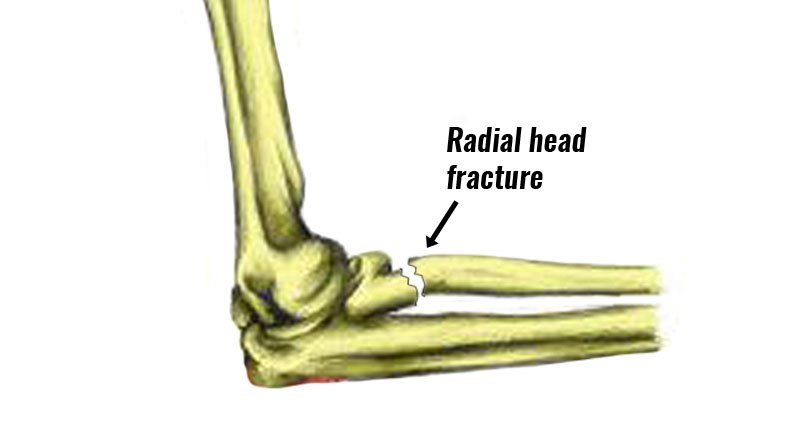 Radial head fracture