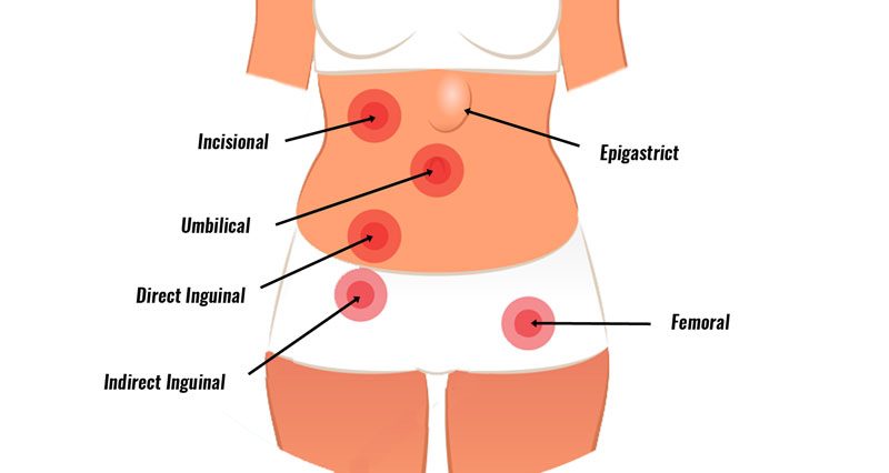 Inguinal Hernia Symptoms & Treatment