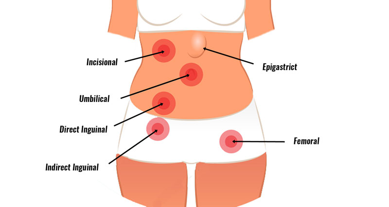 abdominal hernia in adults