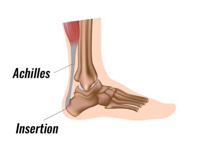 sharp pain heel achilles tendon