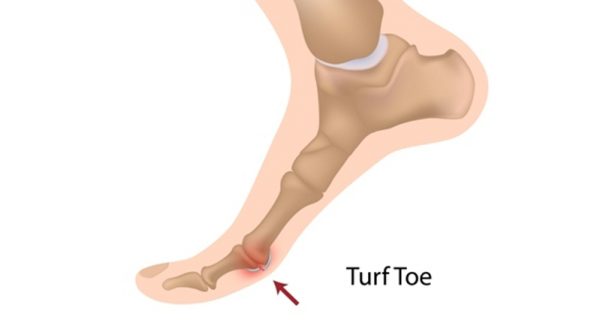 Turf toe