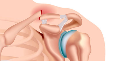 Clavicle fracture