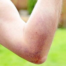 Bruised Elbow