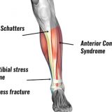 Shin Splints - Symptoms, Causes, Treatment, Taping & Exercises
