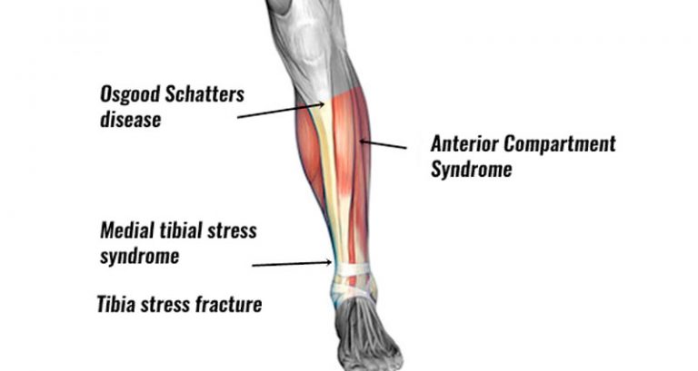 Tibial Stress Fracture - Symptoms, Causes, Treatment & Rehabilitation