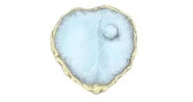 Chondromalacia patella