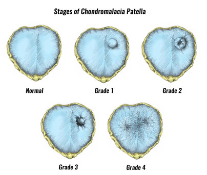 chondromalacia patella stages of injury