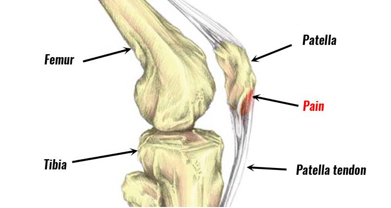 Patellar Tendonitis (Jumper's knee) - Symptoms, Causes and Treatment