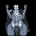 CT Scan - Medical imaging 