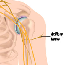 Axillary Nerve Injury