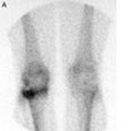 Bone Scan - medical imaging