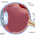 Detached retina eye injury