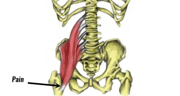 Iliopsoas bursitis