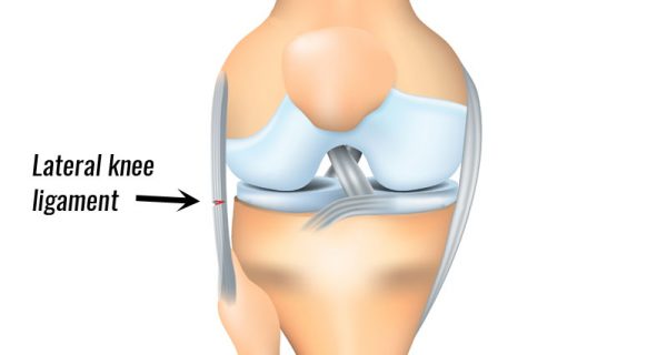 Lateral knee ligament sprain