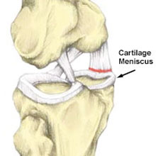 Medial Meniscus Tear