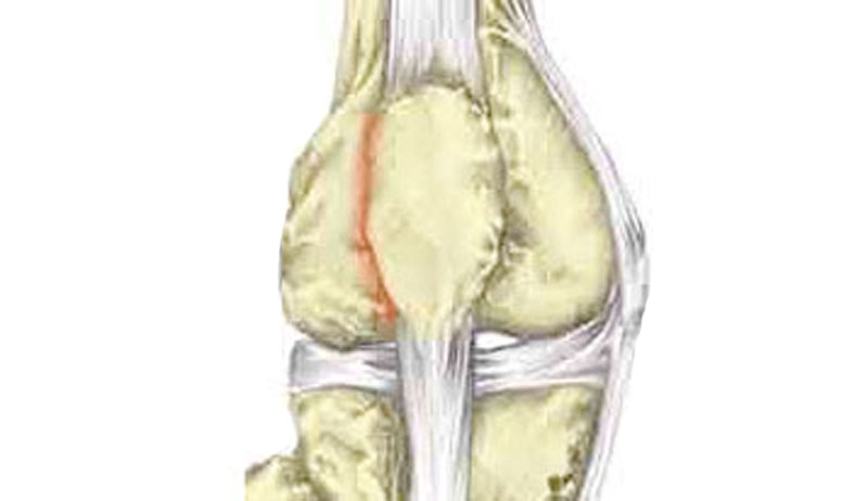 Running knee pain patella