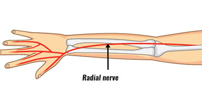 Radial tunnel elbow pain