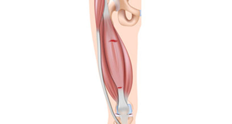 Thigh strain - front thigh pain