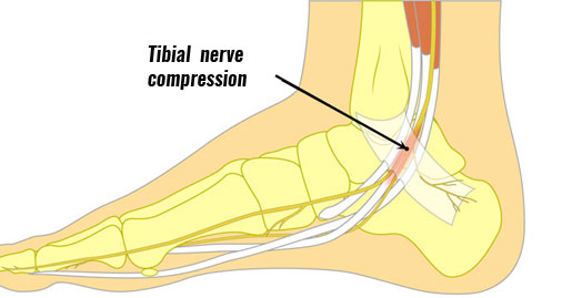 Tarsal tunnel syndrome