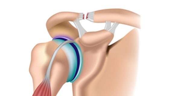 AC joint sprain